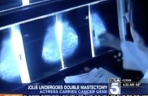 Jolie Mastecomy Live